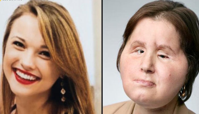 21-year-old woman becomes youngest in United States to receive face transplant