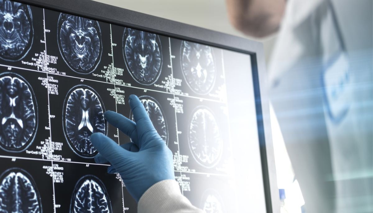 Menopause may affect brain health, triggering Alzheimer's-like changes