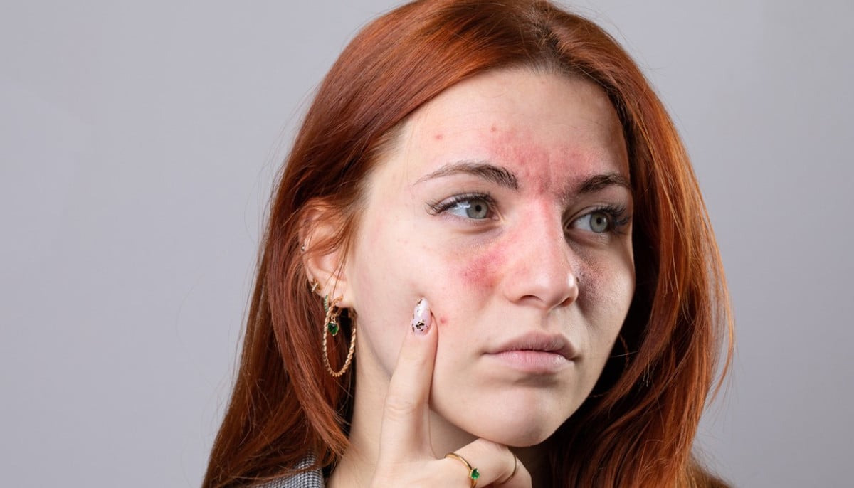 All you need to know guide to rosacea