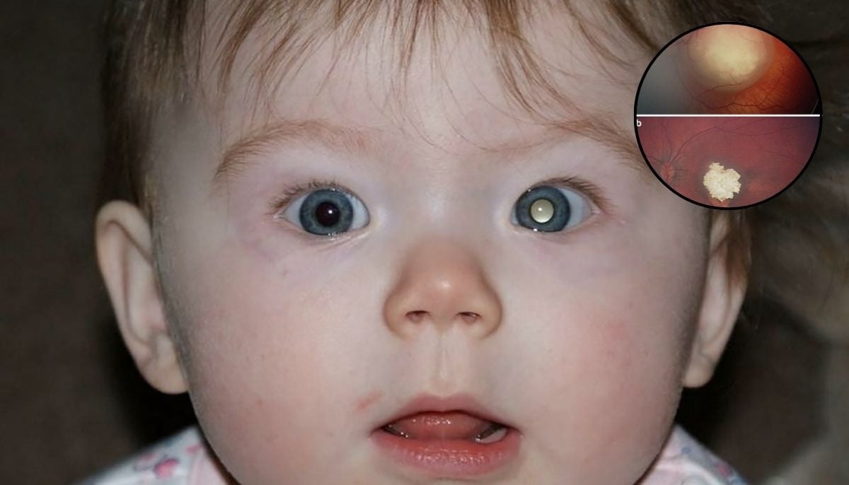 Eye drops made from pig body fluid could revolutionize cancer treatment, new study says