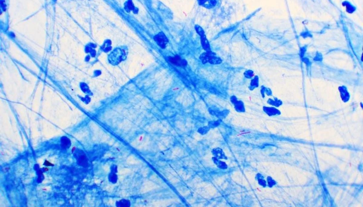 How a new blood test detects active, infectious Tuberculosis: Here’s everything to know