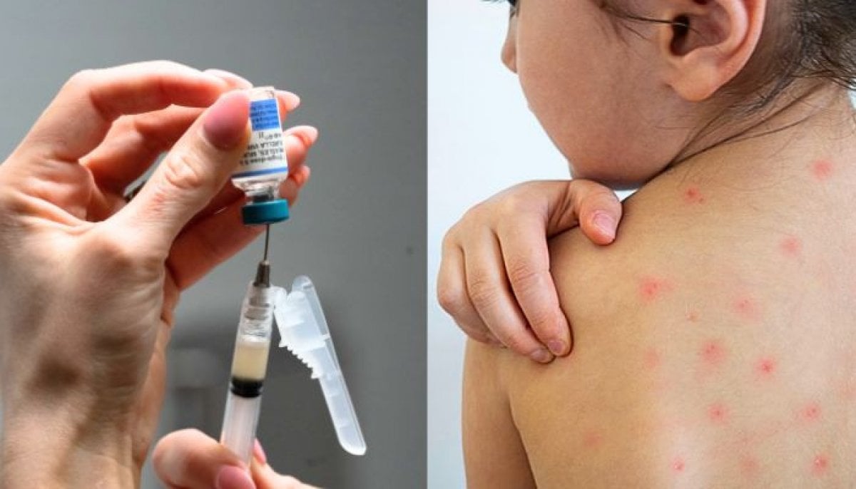 New York declares Measles state of emergency amid nationwide disease resurgence