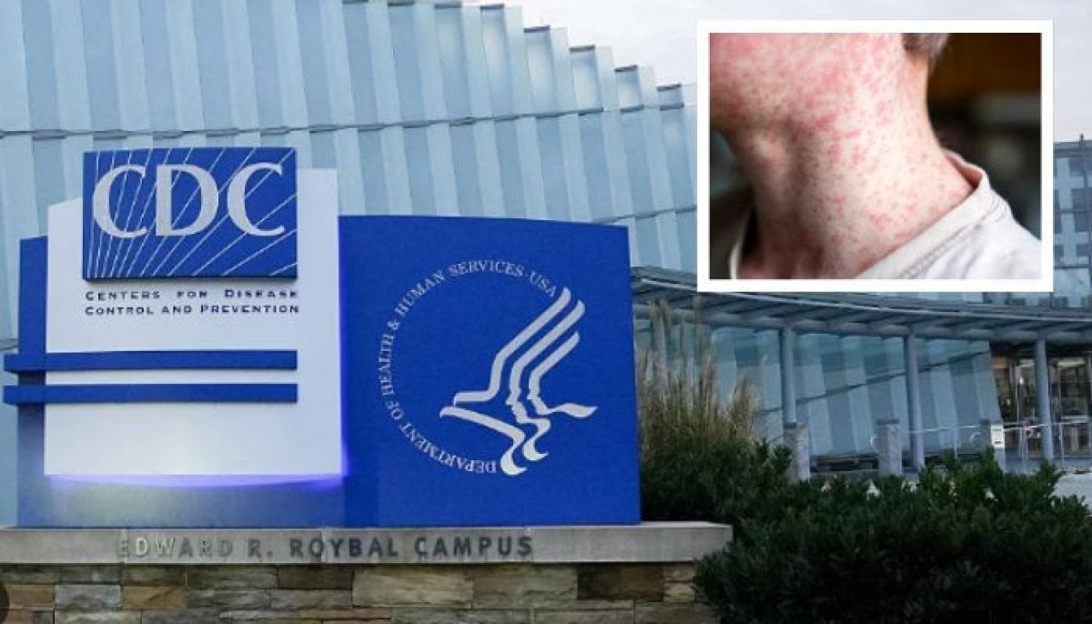 Measles cases in US top 4,000 nationwide, CDC reports