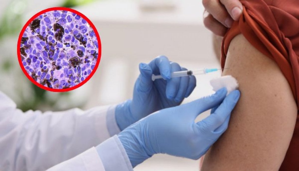New personalized cancer vaccine cuts Melanoma recurrence risk by 42%, trial shows