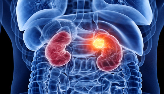 Lifestyle choices, genetic factors are to blame for increasing prevalence of kidney cancer, say experts