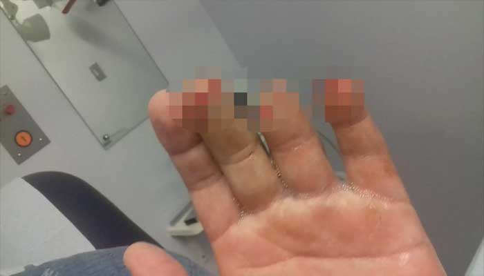 Cop loses fingers in mysterious explosion