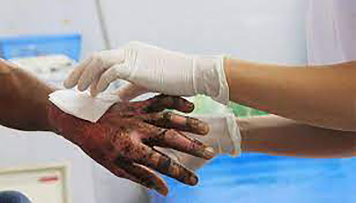 Woman suffers burn injuries