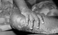 ‘No monkeypox case reported in Pakistan yet’