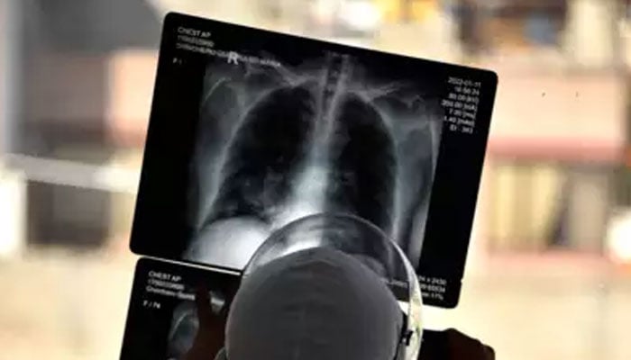 Representational image of a medic looking at an x-ray. — AFP/File