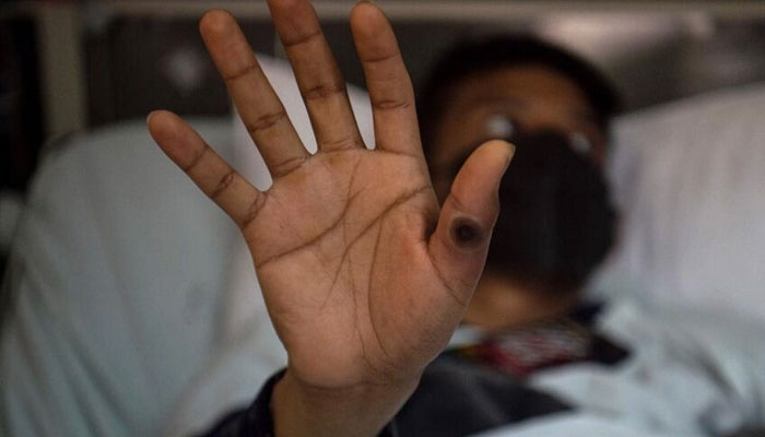 This file photo taken in 2022 shows a patient with a sore caused by monkeypox in Peru.— AFP/file