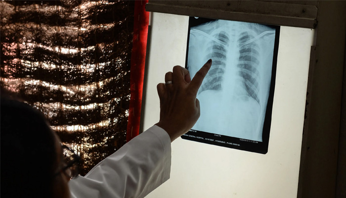 A medic examines a chest x-ray. — AFP/File