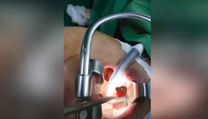 Ahli bedah mengeluarkan lintah hidup dari tenggorokan wanita dalam video viral