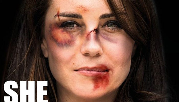 Doctored photo of bruised Kate Middleton sparks fury