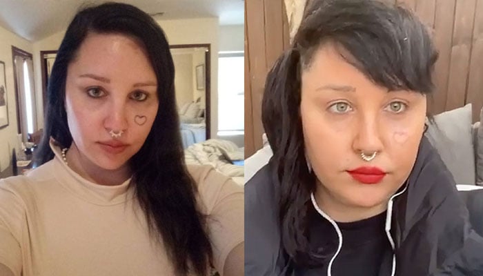 Amanda Bynes unveils she is getting her facial tattoos removed