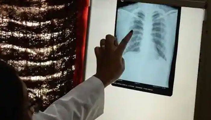 Setelah virus corona, India mencoba mengatasi tuberkulosis