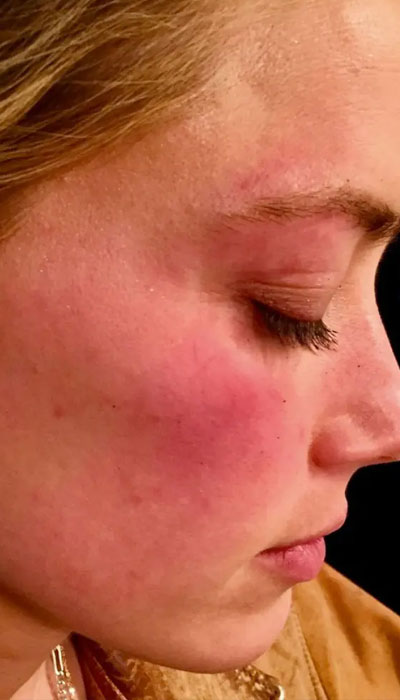 Amber Heards attorneys releases photos of actors bruised face after Johnny Depp hit her with phone