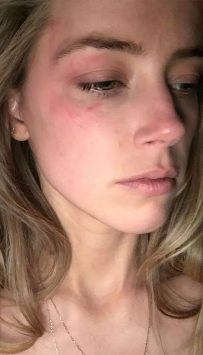Amber Heards attorneys releases photos of actors bruised face after Johnny Depp hit her with phone