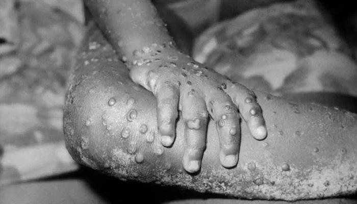 Monkeypox belongs to the family of poxviruses, which includes smallpox. The disease got its name after scientists discovered it among laboratory monkeys in 1958. -Courtesy NBC News