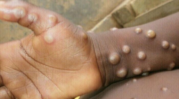 Pakistan on high alert after monkeypox cases detected in UK, US