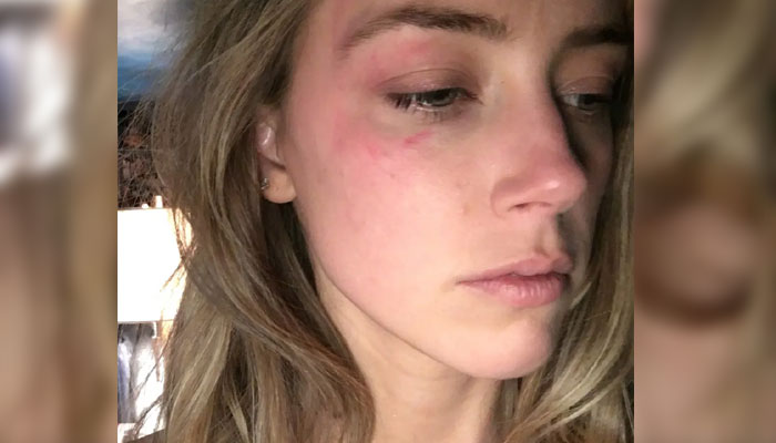 Ex-TMZ employee slams Amber Heard for ‘having staged’ bruise photo-op