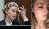 TikToker recreates Amber Heard's bruises: 'So shocking!'