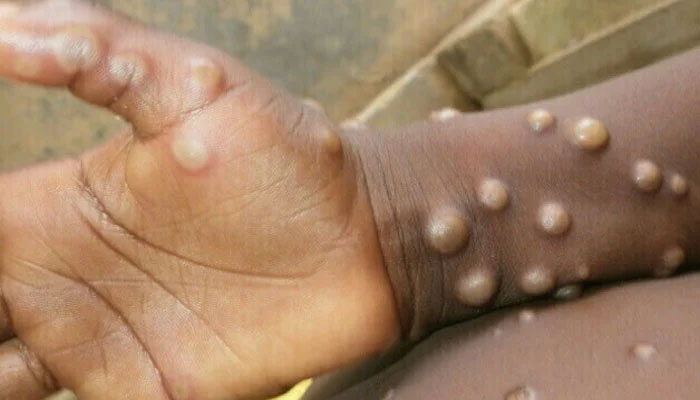 Image showing a person with boils caused by monkeypox on thier hands and forearm. — AFP/file