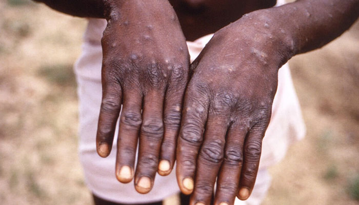The World Health Organization said more than 1,000 monkeypox cases had now been confirmed in non-endemic countries. Photo: AFP/File