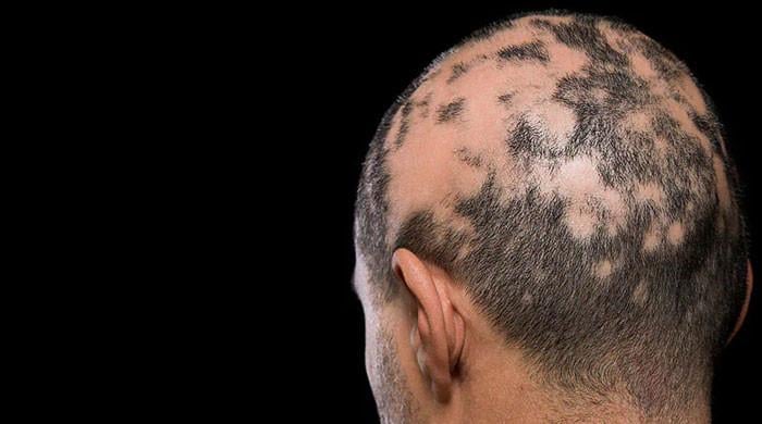 US approves first pill for treatment of alopecia
