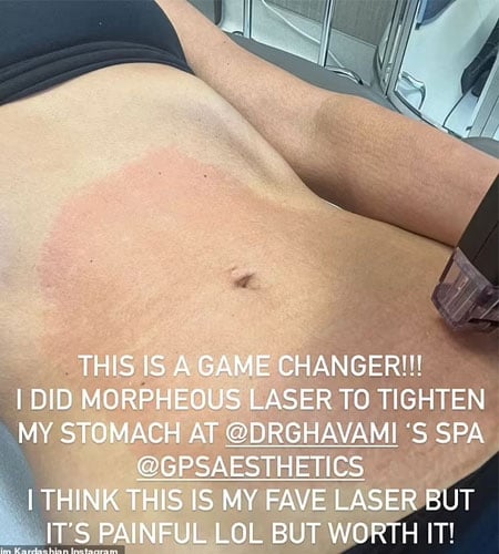 Kim Kardashian gets laser procedure for stomach tightening: ‘its painful’