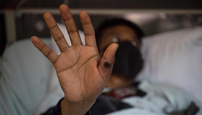A patient shows his hand with a sore caused by an infection of the monkeypox virus, in the isolation area for monkeypox patients at the Arzobispo Loayza hospital, in Lima on August 16, 2022. Nearly 28,000 cases have been confirmed worldwide in the last three months and the first deaths are starting to be recorded. — AFP/File