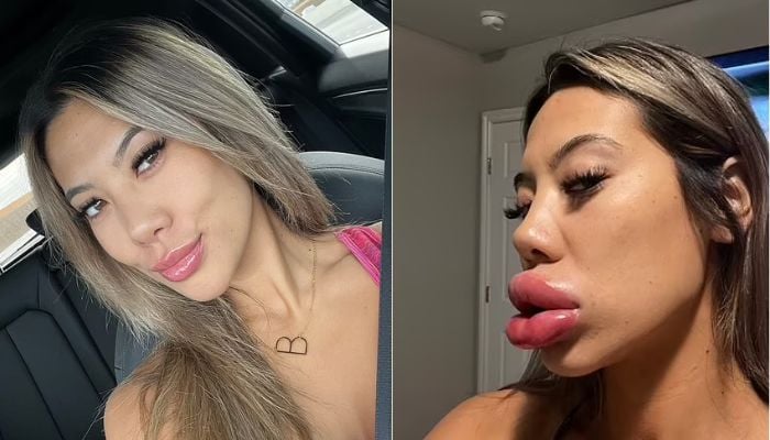 Basia Query, 24, prima e dopo il filler per le labbra.— Social media/@basiaquery