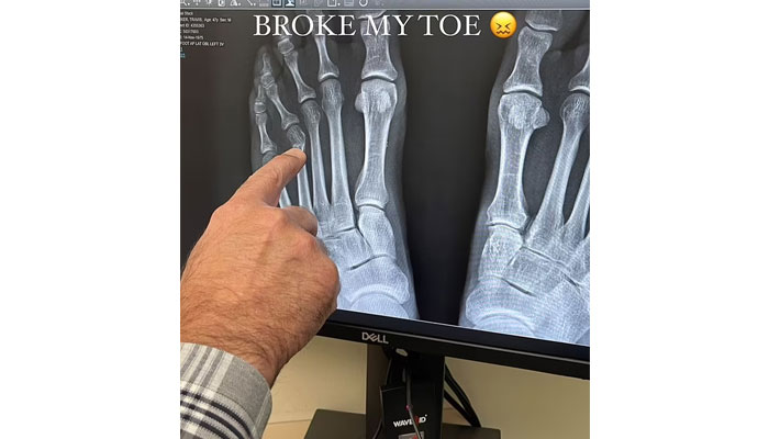 Travis Barker suffers toe injury following birthday celebration with Kourtney Kardashian
