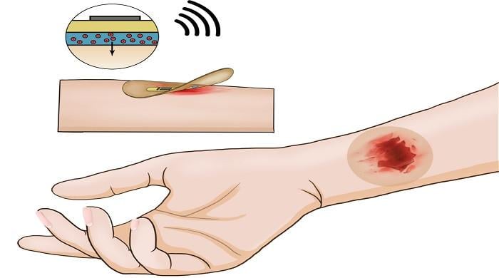 This wireless 'smart bandage' can heal wounds faster