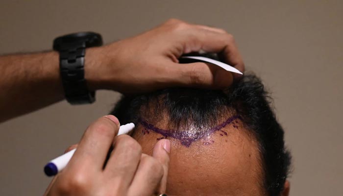 In this photograph taken on Nov. 5, 2022, Dr. Mayank Singh makes hairline markings on the scalp of a hair transplant patient at Crown clinic in New Delhi. — AFP