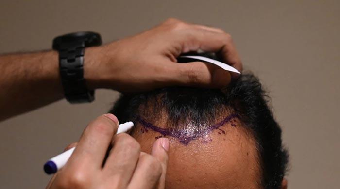 Hair transplant fad turns deadly in India