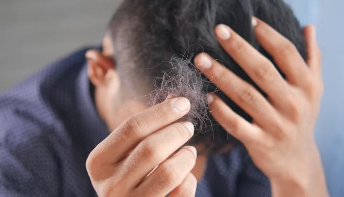 Image shows a man experiencing hair loss. — Unsplash