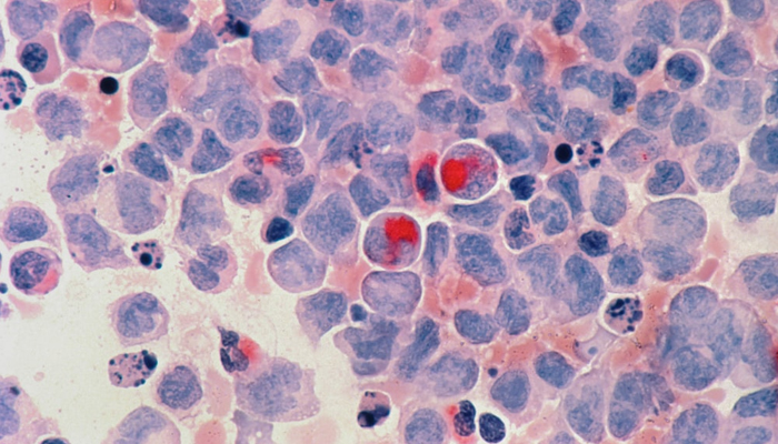 A representational image showing cells of cancer. — Unsplash/File