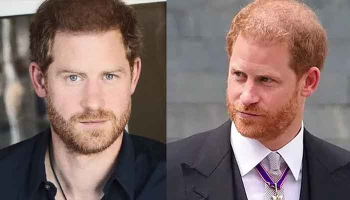 Did Prince Harry really get hair transplant?