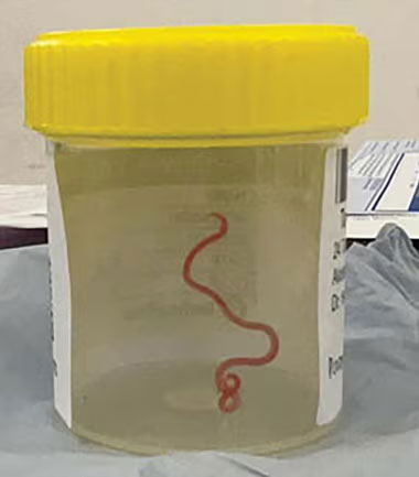 The roundworm specimen after being pulled out of the woman’s brain. Photograph: Canberra Health