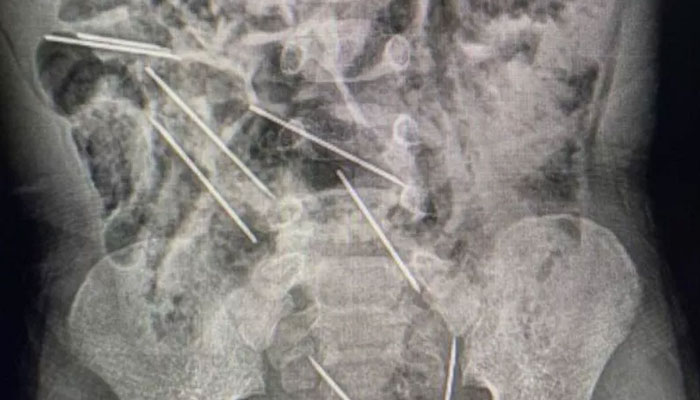 X-Ray of the needles inside the toddler. All eight needed were removed by surgeons. SAN MARTIN REGIONAL GOVERNMENT