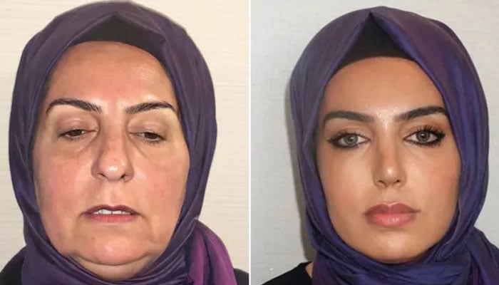 Miss Dilek before and after her transformation at the Turkish clinic. — Instagram @metrof