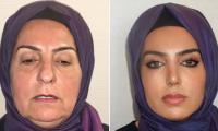68-year-old Turkish woman unrecognisable after cosmetic surgeries — Internet can’t face it