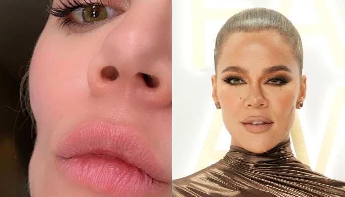 Khloé Kardashian shares cheek ‘Indentation’ pictures left after ‘skin cancer’ tumour removal