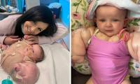 US mother calls daughter 'baby hulk' after she was born with lymphangioma