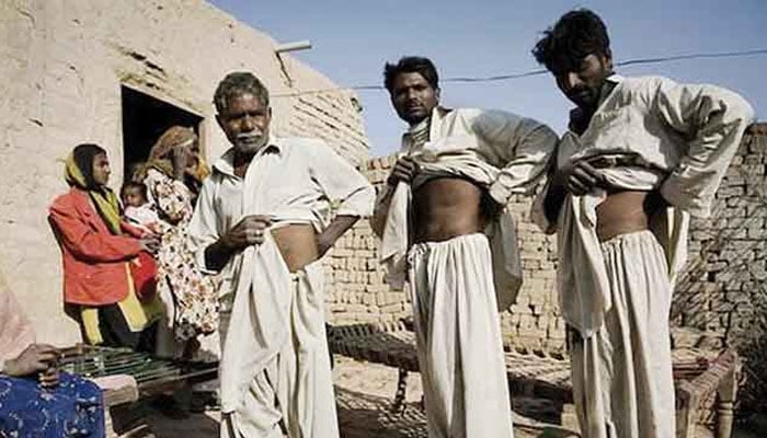 Pakistani villagers showing their surgery scars after selling their organs. — AFP.File