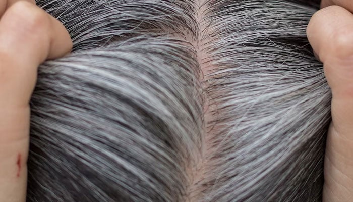 New research has found grey hairs can be reversible if you are able to reduce or eliminate psychological stress.—Canva/File