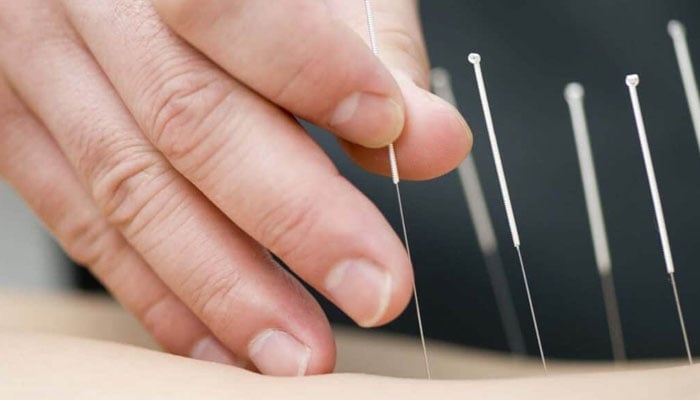 A persons hands holding needles performing the practice of acupuncture. — X/@thephysionortjwales