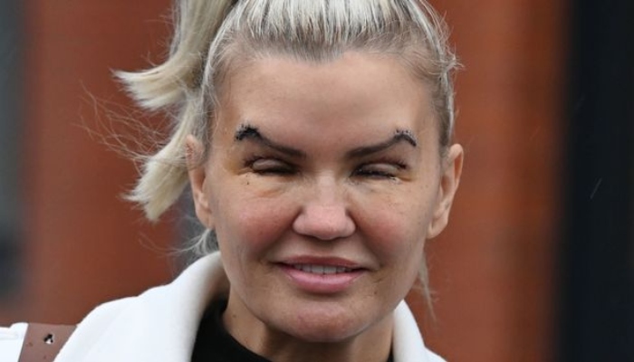 The former Atomic Kitten underwent blepharoplasty, a procedure that eliminates excess skin from the eyelids