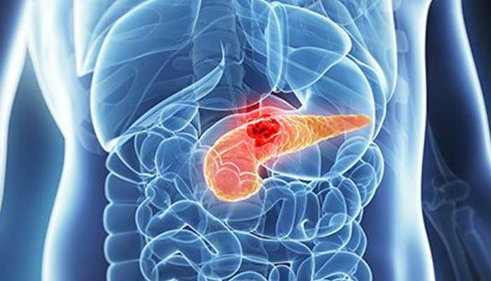 Pancreatic cancer has an average life expectancy of only eight to 11 months. — Gi Cancer/File