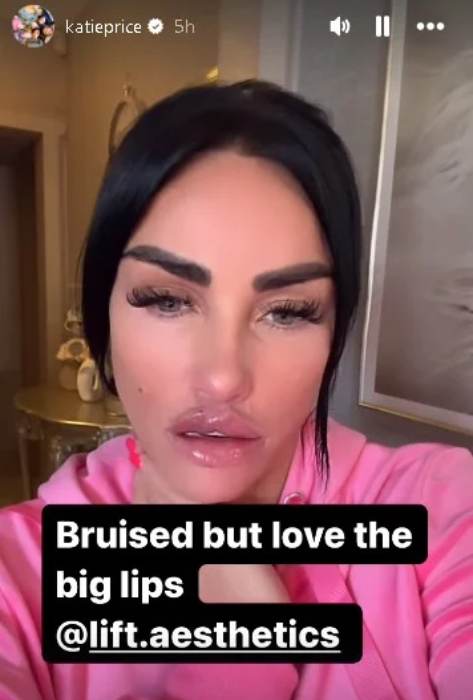 Bruised Katie Price cancelled out getting face filler campaign